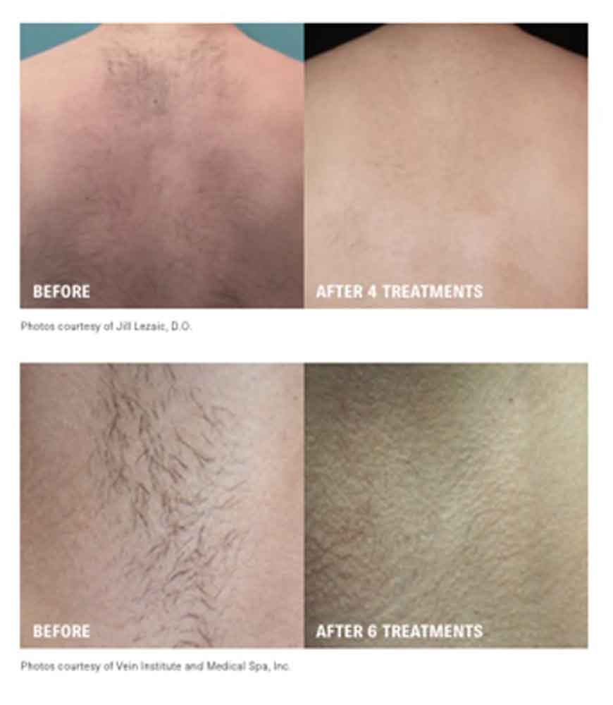 Before and After Treatment Result Hair Removal